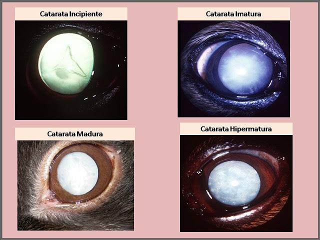 grados de cataratas
