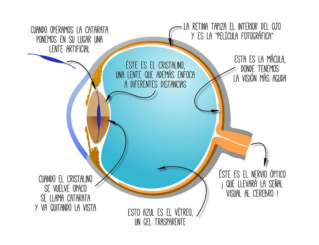 operacion de cataratas facoemulsificación